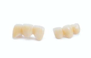 tooth supported bridges