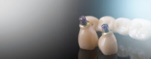 dental implants