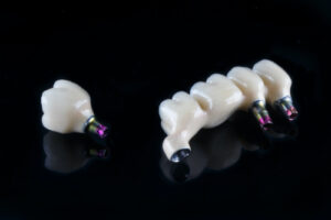 Implant Supported Bridges