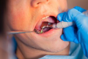 replacing large fillings